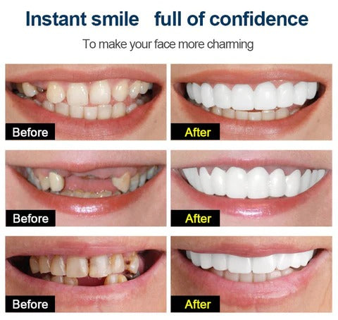 Snap On Braces | Special Teeth whitening Cover